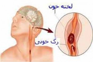 با علائم (TIA) یا سکته مغزی ناقص آشنا شوید