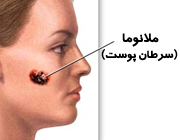 ساخت دارو برای توقف شیوع یک نوع سرطان پوست