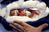 تصاویر/ پزشکان کم وزن ترین نوزاد جهان را از مرگ نجات دادند